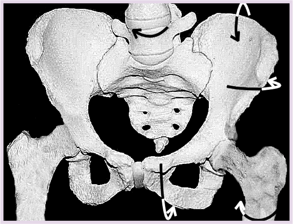 Rotated Pelvis-Anterior View Rotated Pelvis-Anterior View
